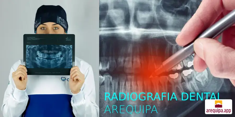 Radiografía dental: prevenir problemas bucales graves